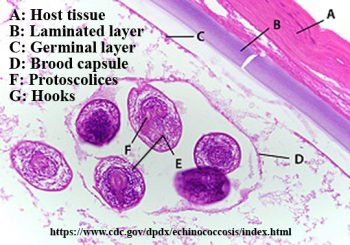 Echinococcus granulosus – Unilocular Hydatid Cyst – Parasitology