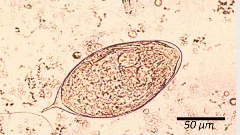 Schistosoma haematobium – Egg – Parasitology