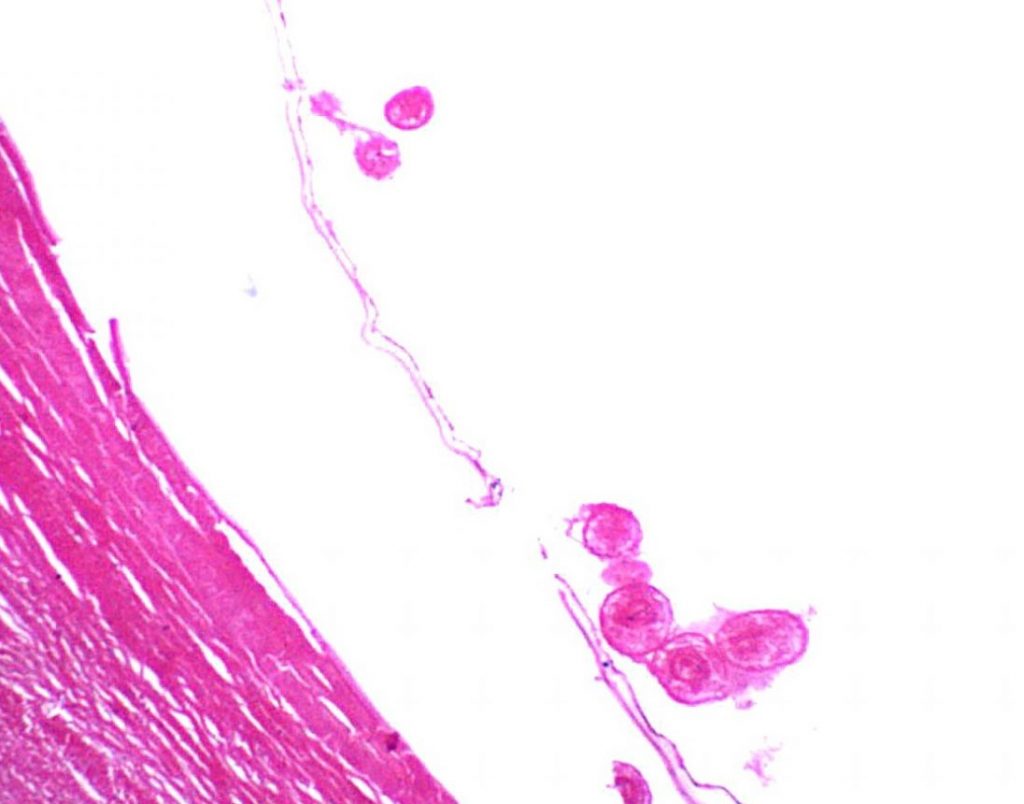 Echinococcus granulosus – Unilocular Hydatid Cyst – Parasitology